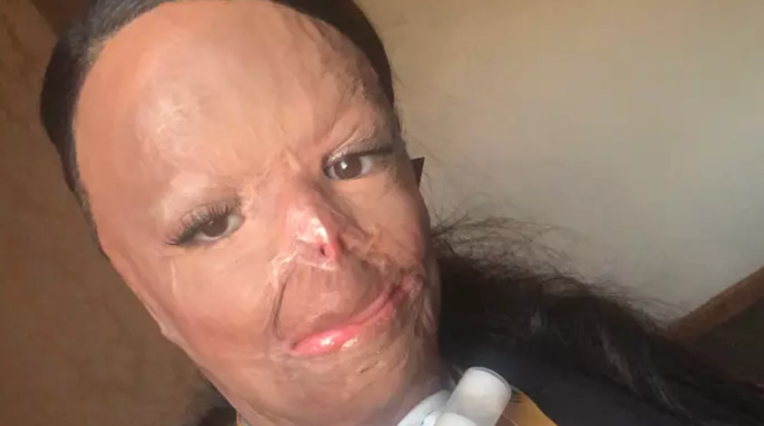 Bit şampuanı yüzünde üçüncü derece yanık oluşturdu