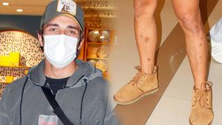 Cemal Can Canseven'in bacağındaki izler dikkat çekti