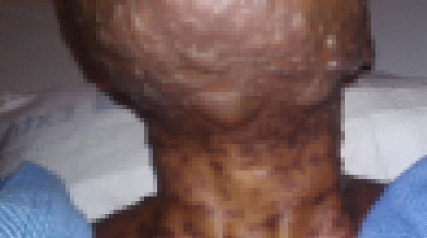 Antibiyotikler onu bu hale getirdi! 'Kırmızı ateş karıncası ısırmış gibi...'