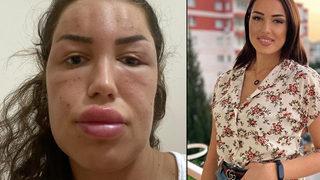 Gençlik aşısı yaptıran kadın tanınmaz halde! Vücudu nodülle kaplandı