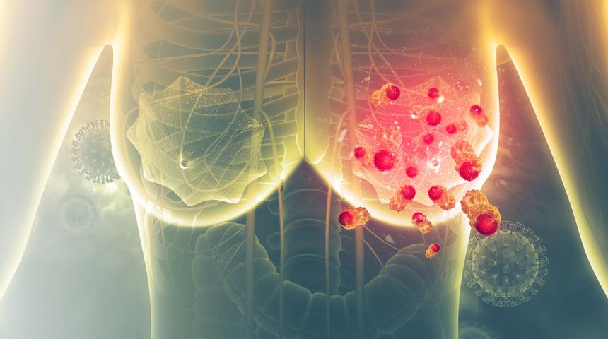 Meme kanserinde erken tanı uyarısı! Tedavinin seyrini değiştiriyor