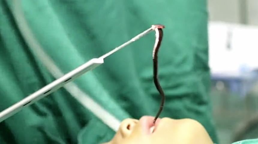 &Ccedil;in'de 5 yaşındaki &ccedil;ocuğun boğazından canlı solucan &ccedil;ıkarıldı