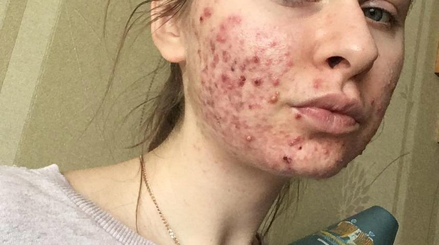 Herkesin başına gelebilir! En sevdiği yiyecek y&uuml;z&uuml;nden dışarı &ccedil;ıkamaz hale geldi 