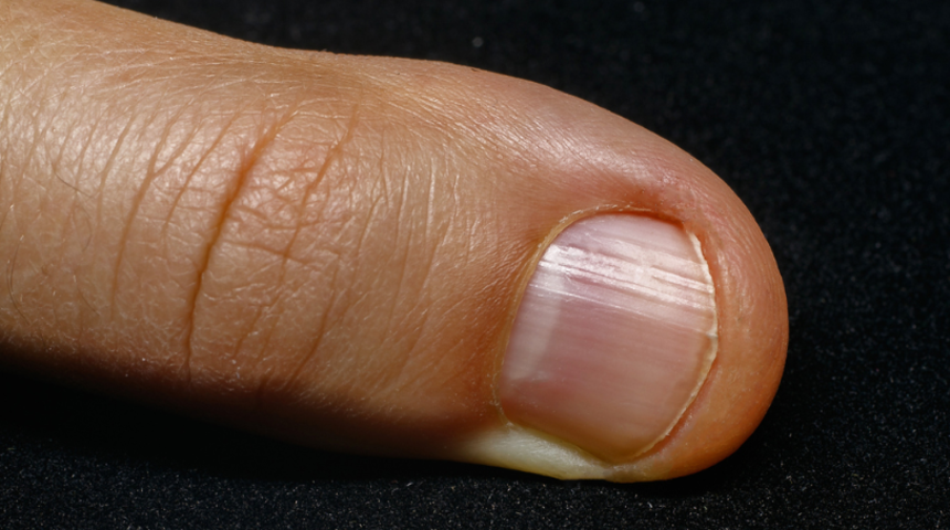 Tırnak diplerinizdeki beyazlıklara dikkatli bakın! Baş parmağımızdaki beyazlık...
