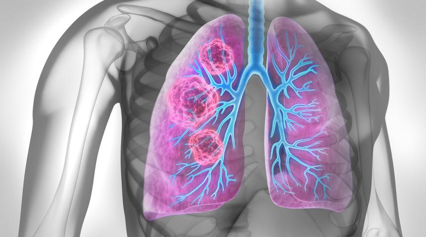 Akciğer kanseri belirtileri b&ouml;yle başlıyor!