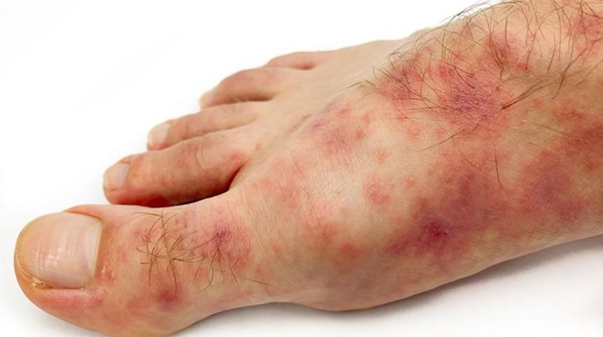 Yeni hasar: Kovid ayak parmakları