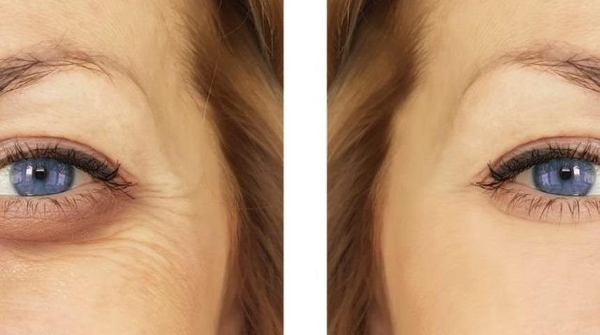 Artık gizlemeyeceksiniz! Göz altı morluklarını yok eden kesin yöntem