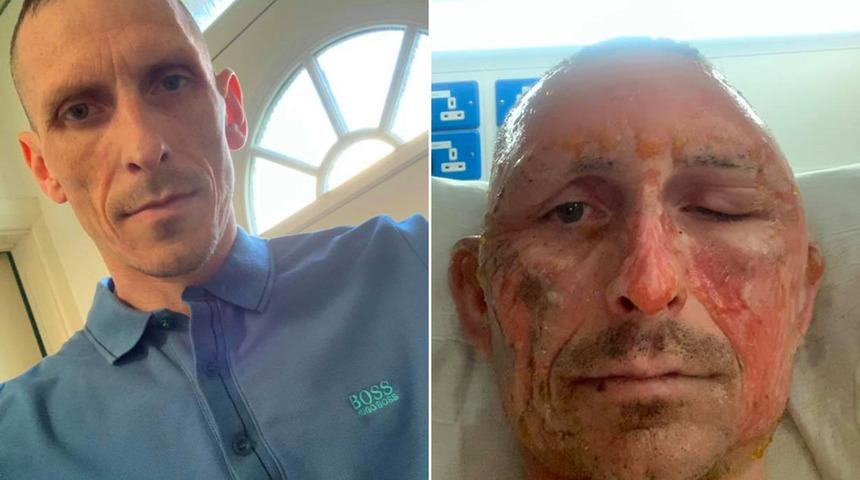 Dezenfektan yüzünden elleri tutuşan adam alevler içinde kaldı