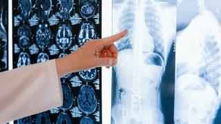 Akciğer sönmesi nedir? İşte belirtileri ve tedavisi