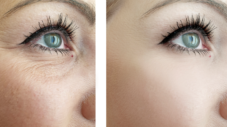 Kazayağı kırışıklıkları nasıl tedavi edilir?