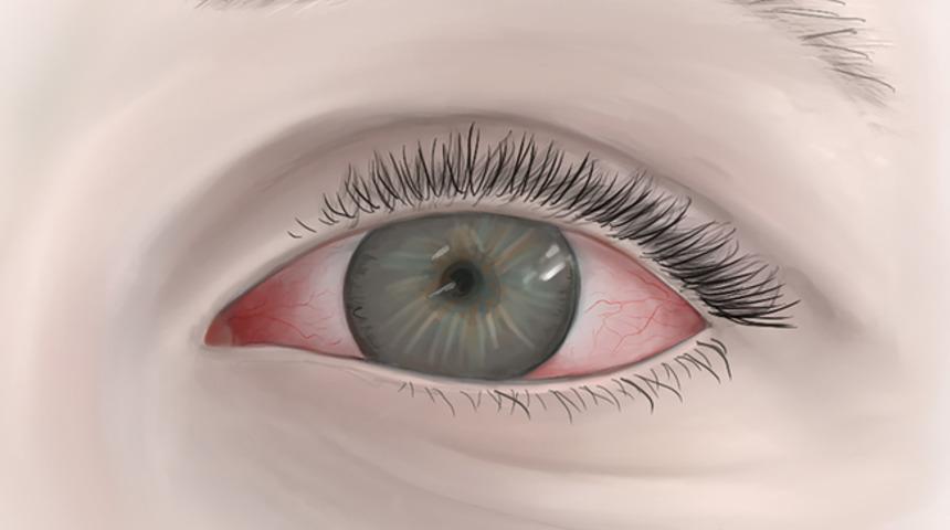 Göz kanlanmasına ne iyi gelir? Göz kanlanması evde doğal yöntemlerle tedavi edilebilir mi?