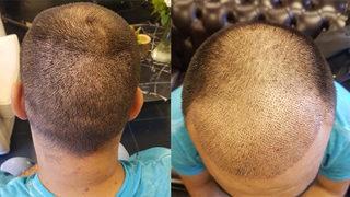 Saç ekimi sonrası hayatını kaybetti! Klinikte inceleme yapıldı