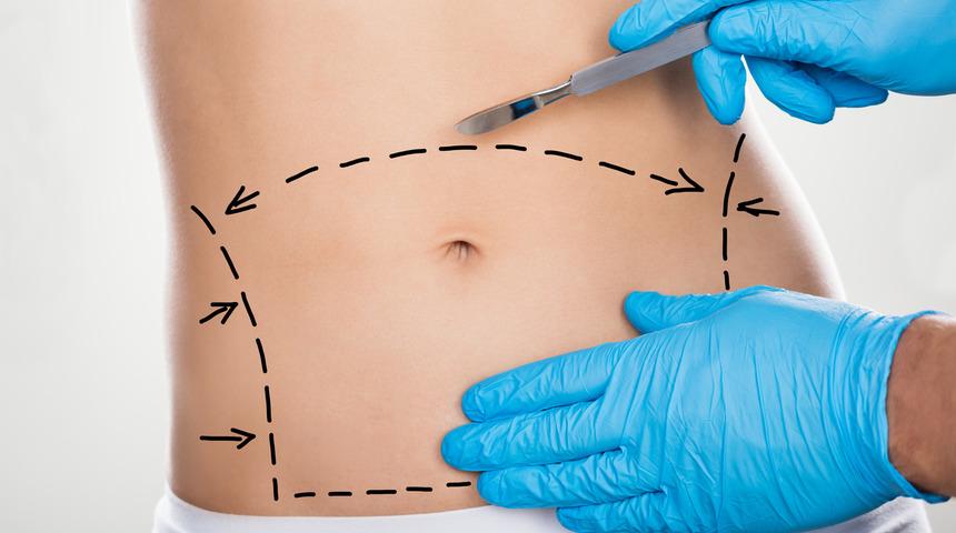 Op. Dr. Yunus Doğan açıkladı: Karın germe estetiğinde bunlara dikkat!