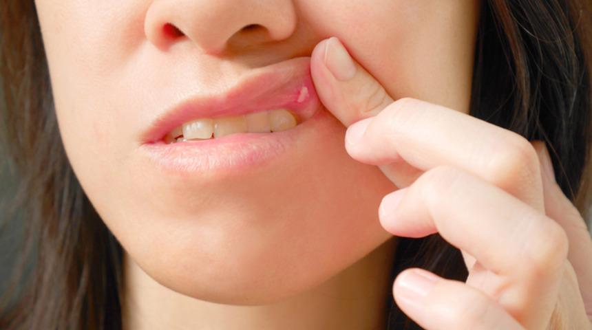 Ağız yarasına ne iyi gelir? Ağız yarası (Aft) doğal tedavi yöntemleri ile iyileşir mi?