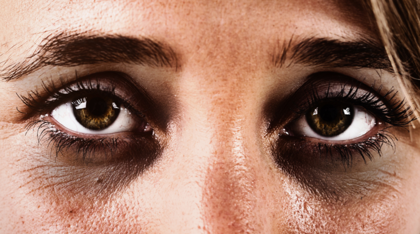 Uykusuzluktan kaynaklandığını düşünüyoruz ama... Göz altındaki koyu halkalar...