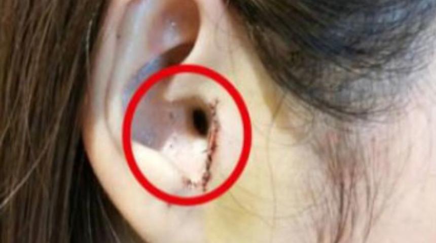 Uyandığında şoka girdi! Burun estetiği yaptırdı, kulağından oldu