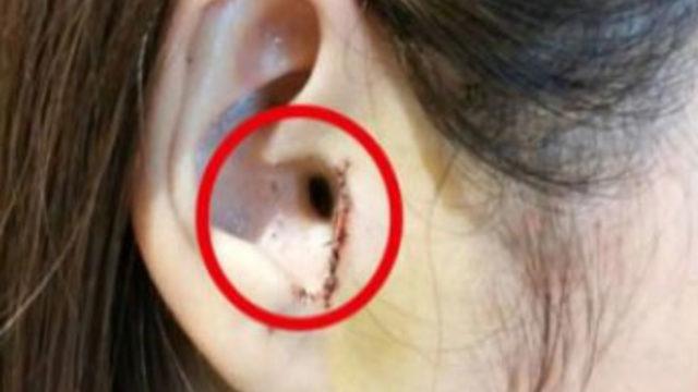 Uyandığında şoka girdi! Burun estetiği yaptırdı, kulağından oldu