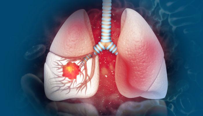 Akciğer kanseri tedavisi ölüm oranlarını azaltıyor