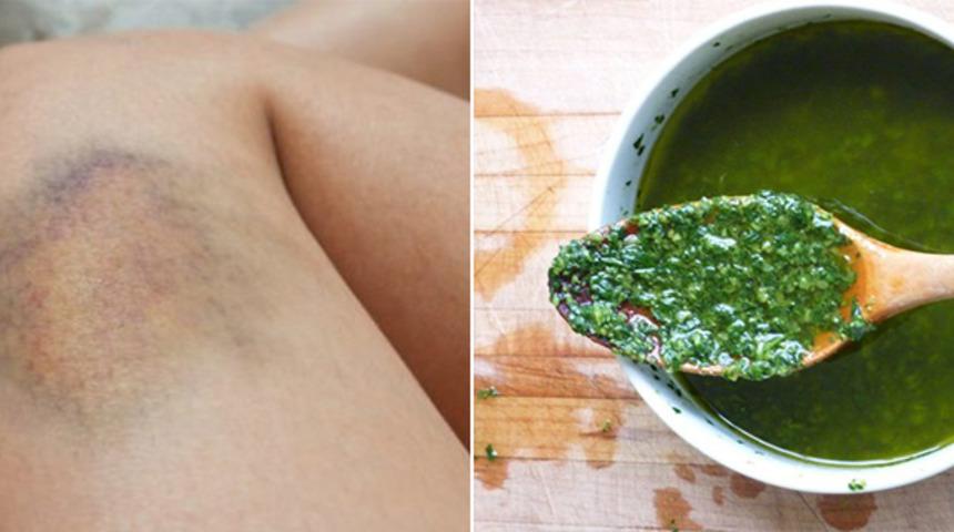 G&uuml;zelliğinize g&ouml;lge d&uuml;ş&uuml;ren morluklardan kolayca kurtulmanın 9 yolu