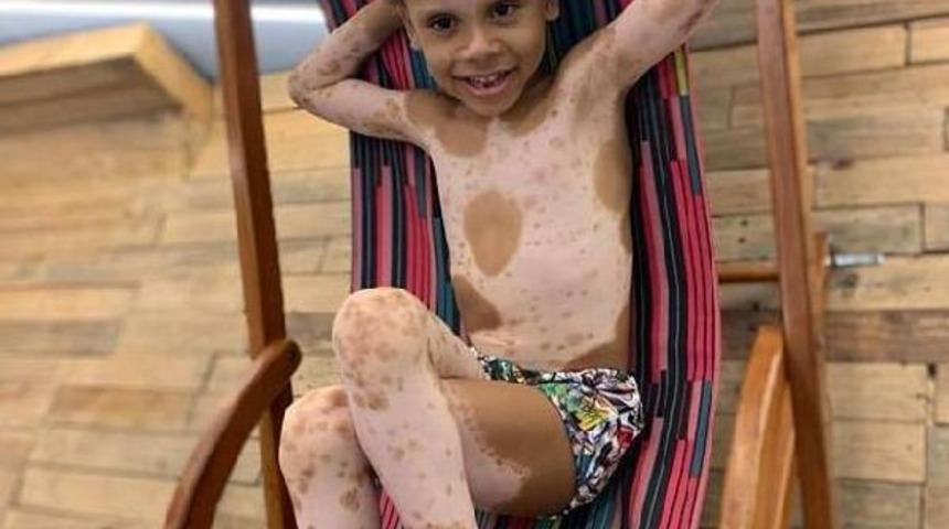 Nadir deri hastalığı olan &ccedil;ocuk, uluslararası model oldu