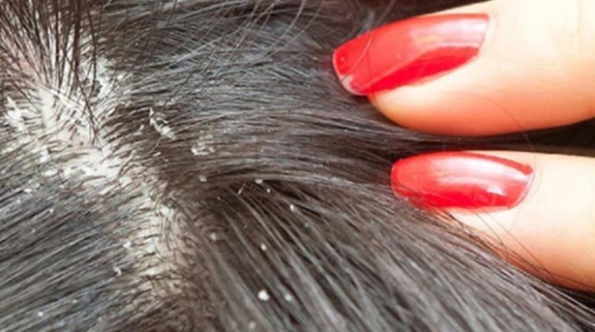 Sa&ccedil; derisindeki egzama ile başa &ccedil;ıkmanın 6 yolu