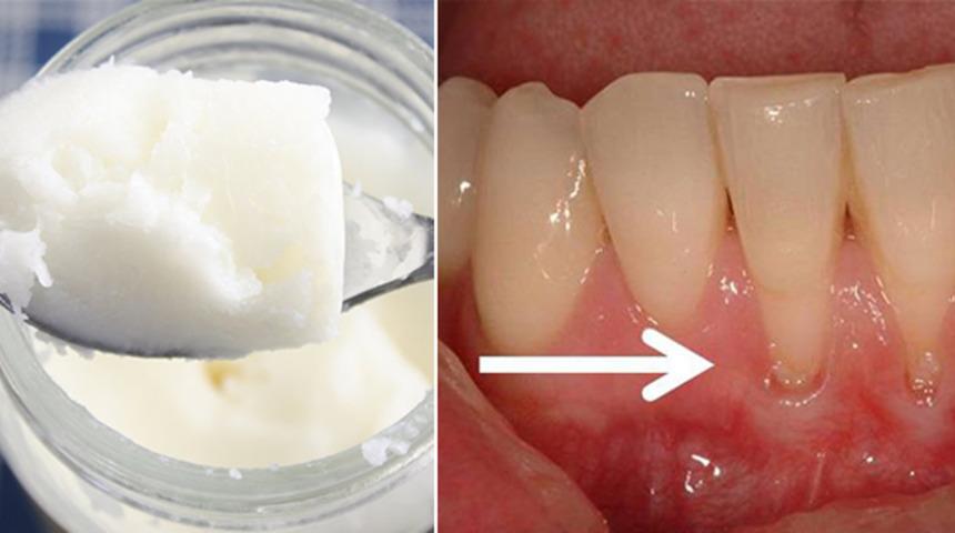 Yağ peelin'gi ile b&uuml;t&uuml;n diş ve diş eti hastalıklarına veda edin