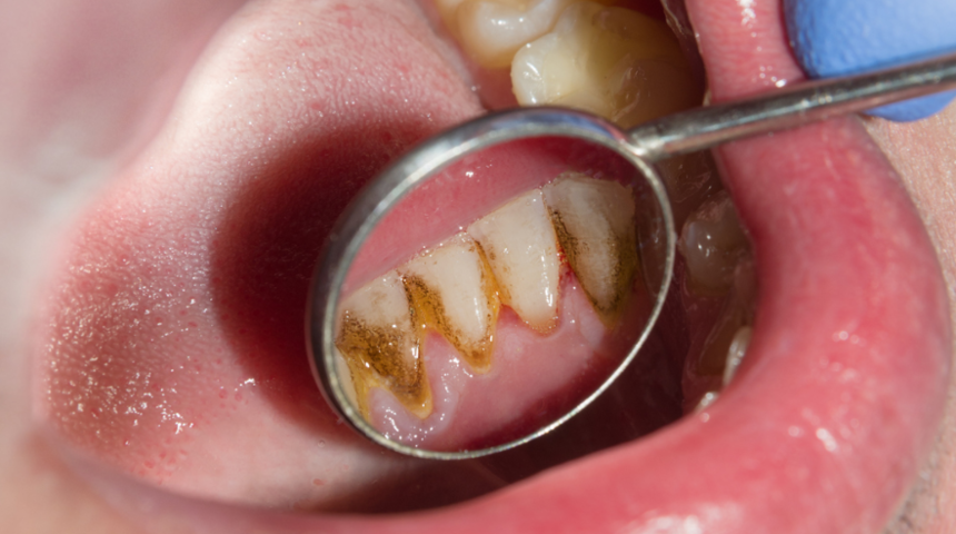 8 b&uuml;y&uuml;k hata! Dişler bu y&uuml;zden &ccedil;&uuml;r&uuml;yor diş fır&ccedil;ası bile &ccedil;ıkaramıyor