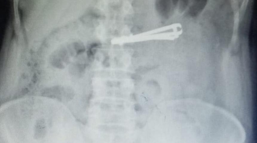 Yuttuğu tırnak makası ameliyatla alınan hasta sağlığına kavuştu