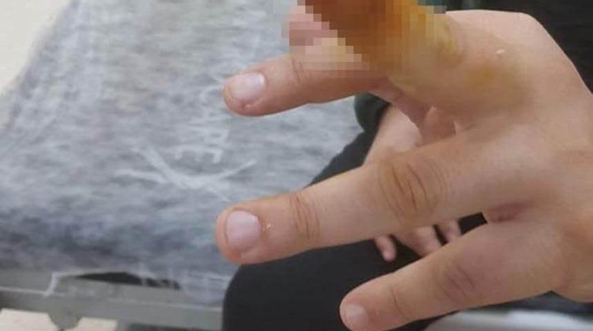 Hastanede korkunç olay! Tartıştığı güvenlik görevlisinin parmağını ısırıp, kopardı