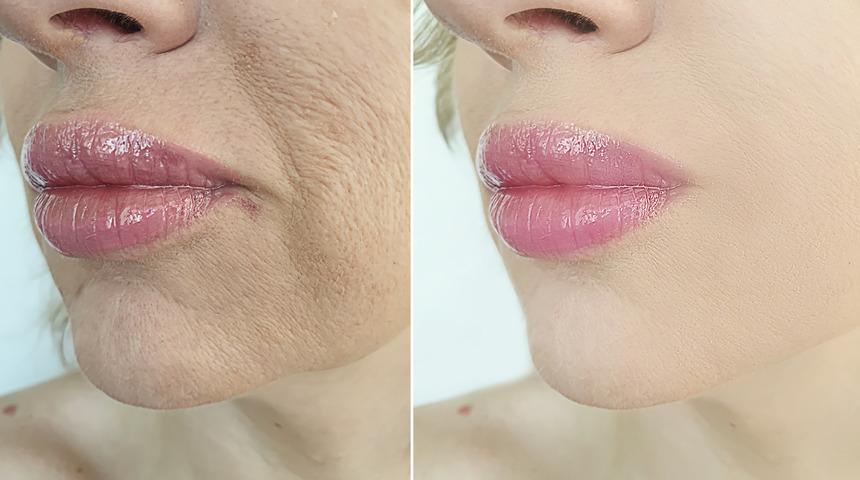 Ünlü isimler yaptırıyor ama uzak durun! Botoks sağlığınızın sonu olabilir