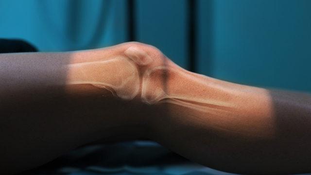 Diz ağrısı nedenleri nelerdir? Kireçlenmeye dikkat