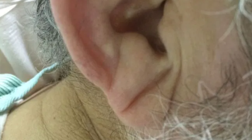 Kulaklarınıza &ccedil;ok dikkatli bakın! Buruşuk kulak memeniz varsa...