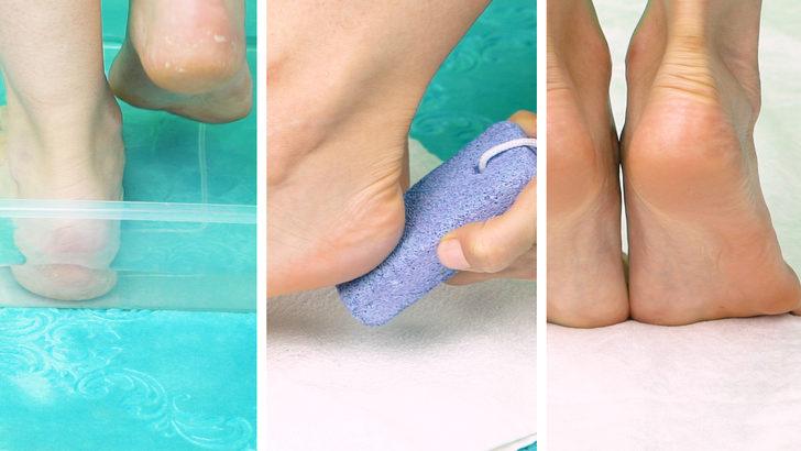 Topuk çatlağını anında gideren 2 kür