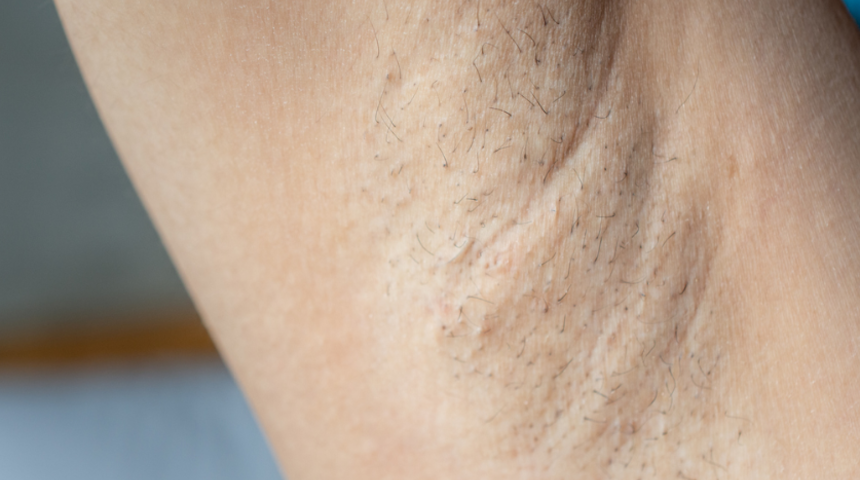 Ev yapımı, doğal mı doğal! Koltuk altı tüylerini azaltmak için...