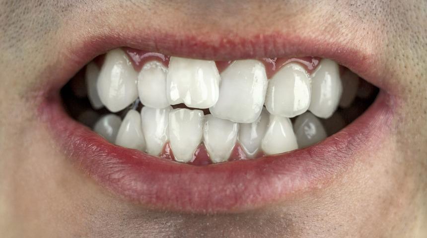 &Ccedil;apraşık dişlerle g&uuml;l&uuml;ş&uuml;n&uuml;z&uuml; gizlemeyin