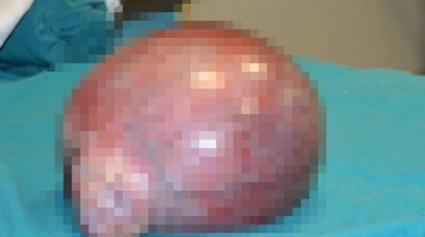 Ağrı şikayetiyle doktora gitti, karnında 14 kilo kitle olduğunu &ouml;ğrendi