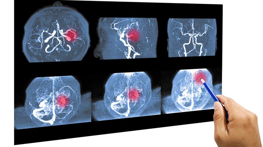 Beyin anevrizması belirtilerinde bu dörtlüye dikkat!