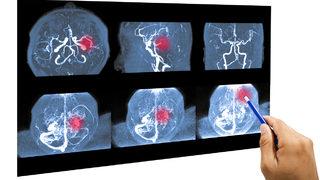 Beyin anevrizması belirtilerinde bu dörtlüye dikkat!