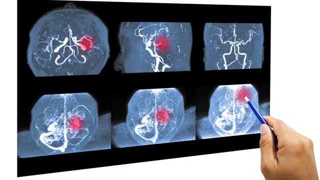 Beyin anevrizması belirtilerinde bu dörtlüye dikkat!