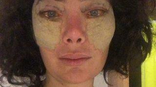 Akasya Asıltürkmen kaş kaldırma estetiği yaptırdı! 'Tırsa tırsa gittim yaptırdım'