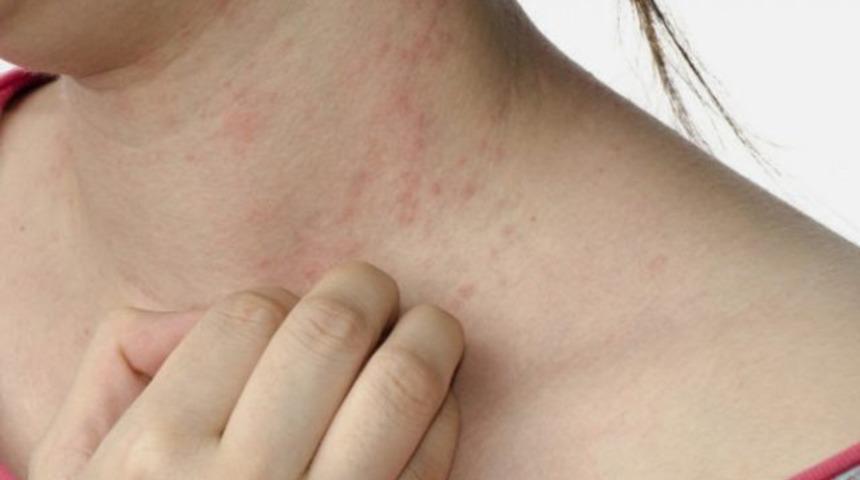 V&uuml;cuttaki parazit belirtileri neledir?