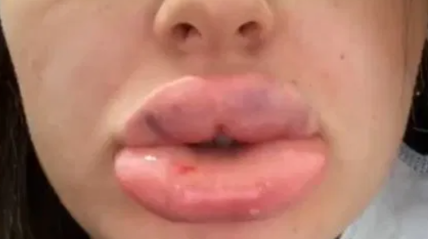 Dudak dolgusuna doymadı! 'Sosis gibi oldu ama yine yaptıracağım'