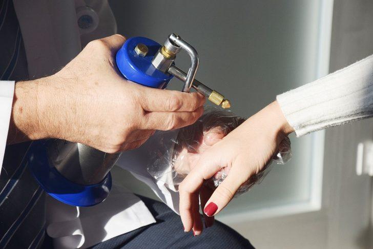 Siğil ve güneş lekelerine karşı ’Kriyoterapi’ G2