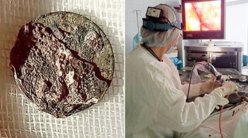 Çocukken burnuna sıkışan bozuk para 53 yıl sonra çıkarıldı