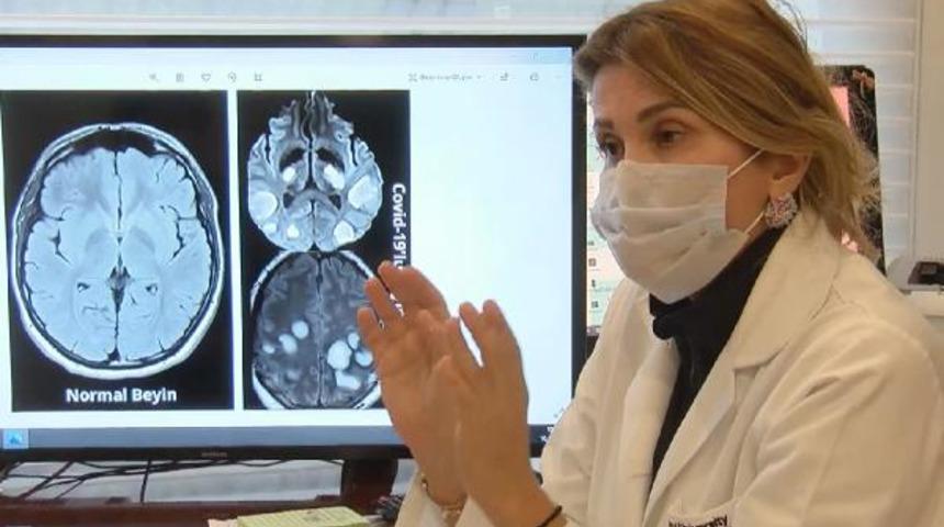 Baş ağrısıyla ilgili dikkat çeken açıklama! Koronavirüs belirtisi olabilir