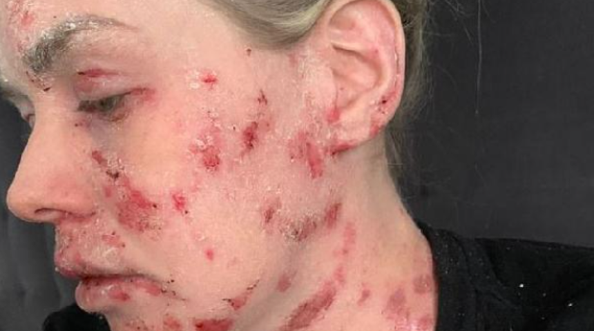 Egzama kremleri kullandı y&uuml;z&uuml; tanınmaz hale geldi! Aylarca...