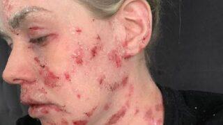 Egzama kremleri kullandı yüzü tanınmaz hale geldi! Aylarca...