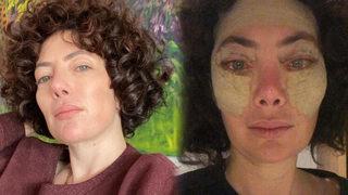 Akasya Asıltürkmen estetik olmuştu! İşte son hali...