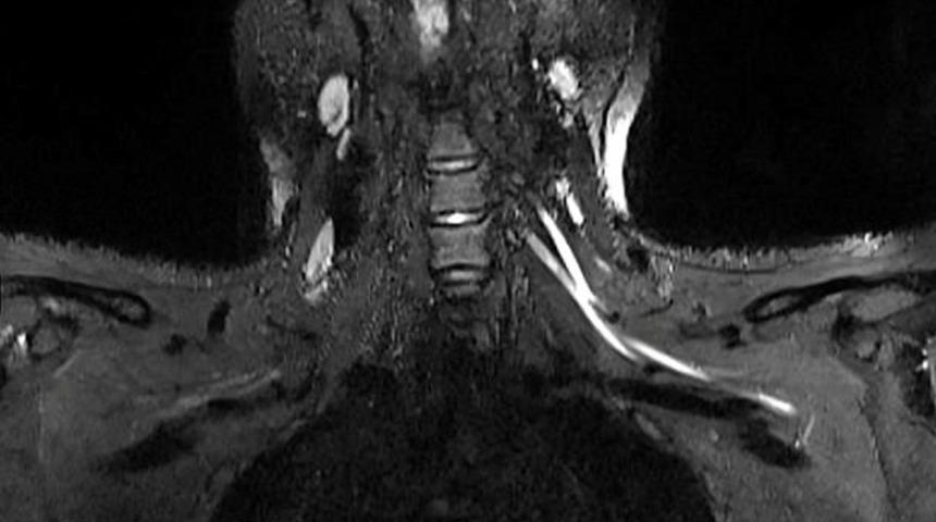 Korona neden ağrı yapıyor? İlk kez görüntülendi