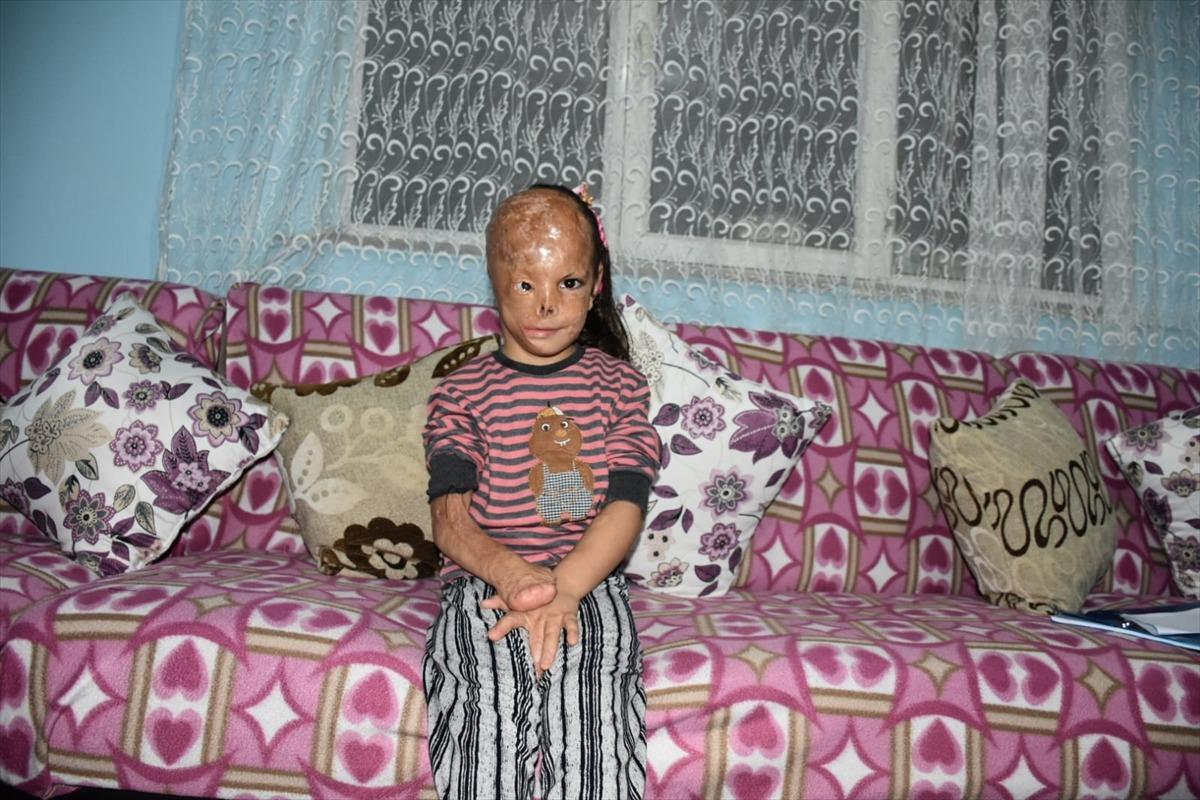 Bebekken y&uuml;z&uuml; yanan 5 yaşındaki Dilara ameliyat olmak i&ccedil;in yardım bekliyor